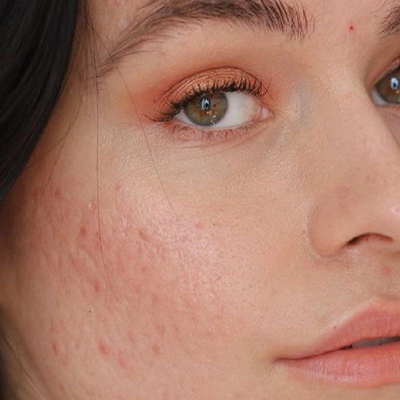 Acne, Simplified: A Clearer Routine with Clean, Targeted Skincare